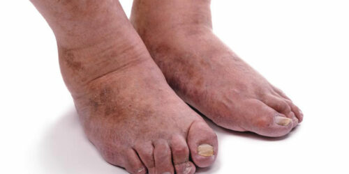 4 important things you need to know about rheumatoid arthritisÂ