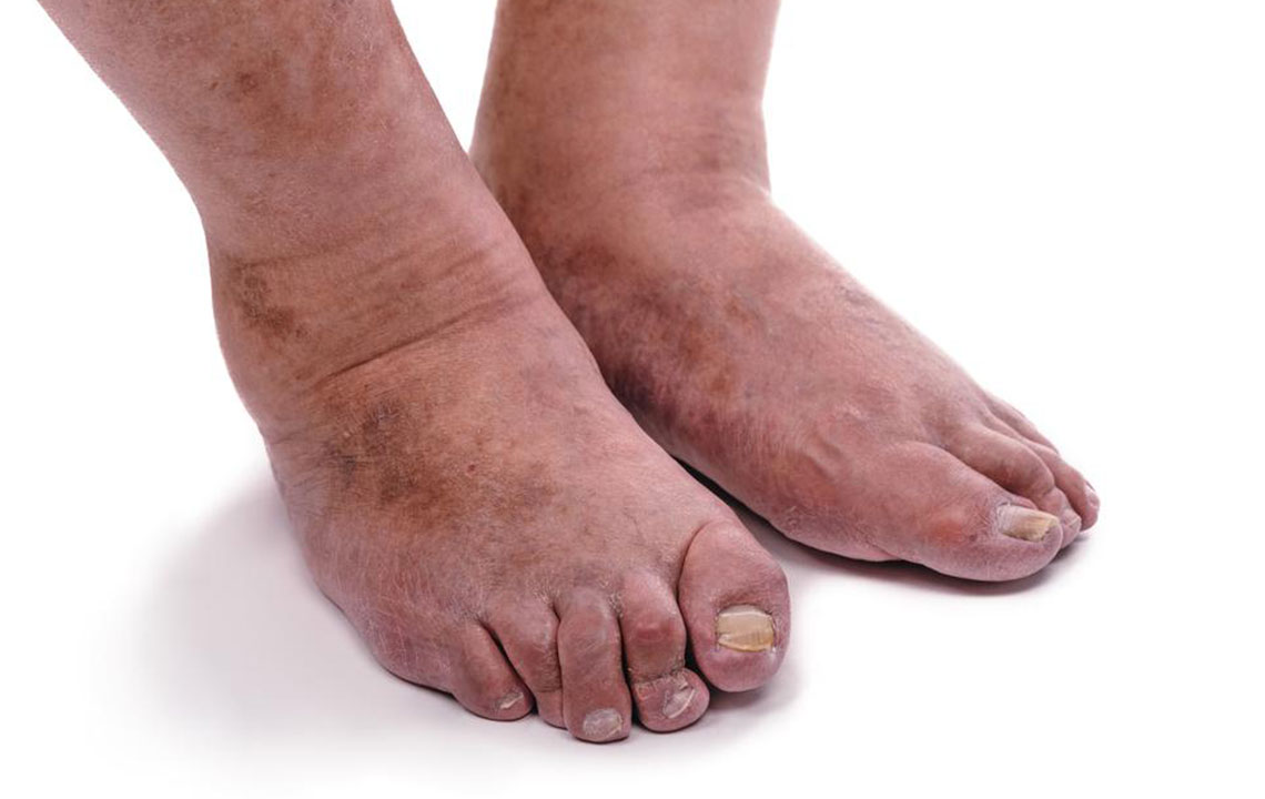 4 important things you need to know about rheumatoid arthritisÂ
