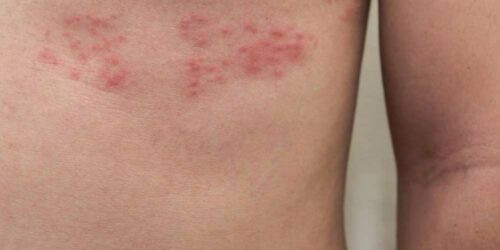 5 Ways to Deal with Shingles Nerve Pain