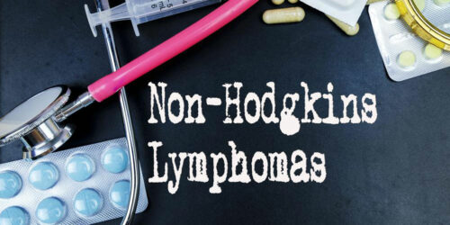 6 common risk factors for Non-Hodgkin lymphoma