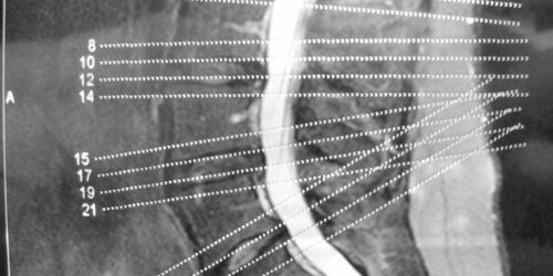 A brief overview of degenerative disc and joint disease