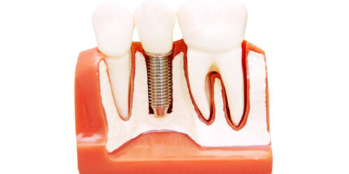 All you need to know about permanent dentures