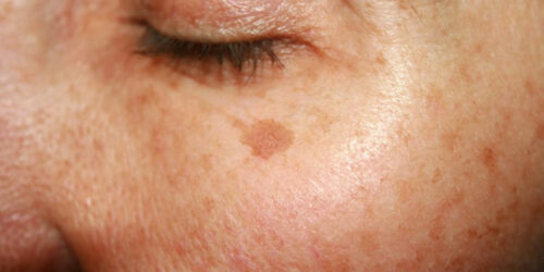 Cheap, effective remedies lighten age spots naturally