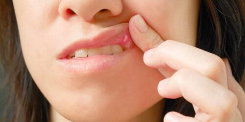 Common Reasons for Sores in the Mouth