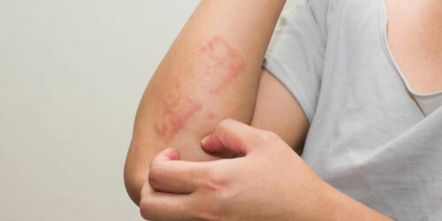 Here&#8217;s all that you need to know about scabies skin rash