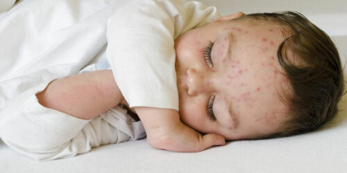 Here&#8217;s how to treat skin rashes in babies