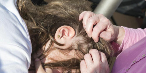 Home remedies for treating head lice