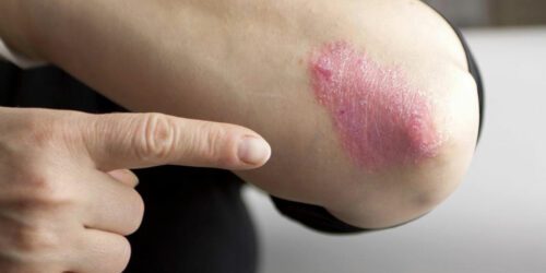 Moderate to severe plaque psoriasis treatment