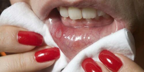 Mouth Cancer – Causes and Symptoms