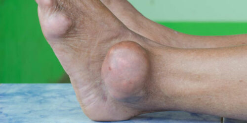 Preventive care for dealing with gout foot pain