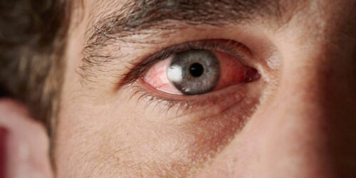 Sjogren’s Syndrome- Causes and Symptoms