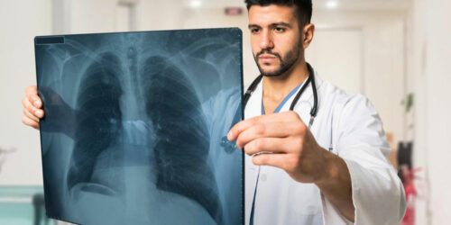 The 3 main signs of lung cancer