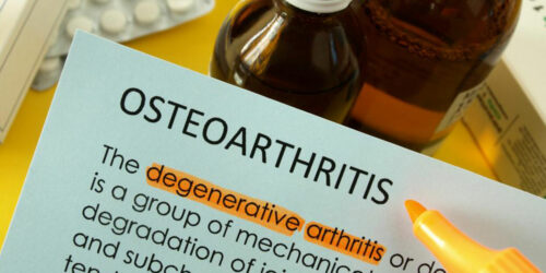 What are the treatment options for managing osteoarthritis