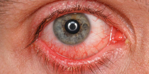 A Few Common Symptoms, Causes, And Treatments of Pink Eyes