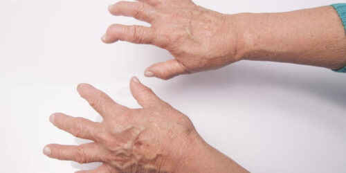 All You Need to Know About the Diagnosis of Rheumatoid Arthritis