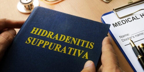 All You Need to Know about Hidradenitis Suppurativa