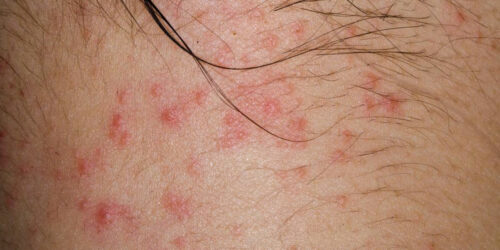 An Introduction to the Types of Itchy Skin Rashes