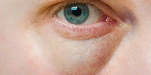 Bags Under the Eyes – Symptoms, Causes, and Treatment