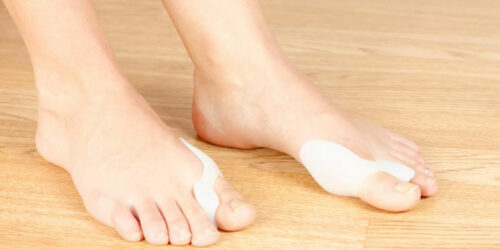 Bunion Treatment &#8211; All You Need to Know