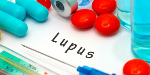 Causes and Symptoms of Lupus