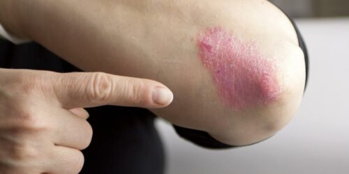 Causes of psoriasis that one needs to be aware of