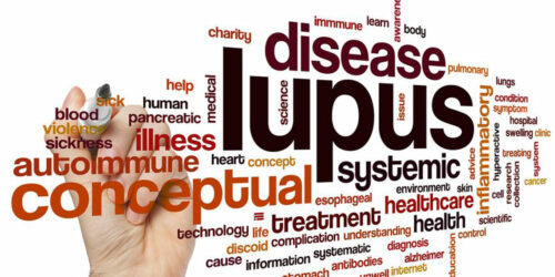 Common Symptoms of Lupus in Women