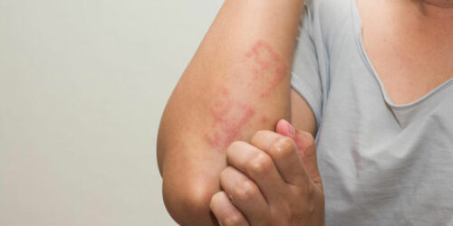 Dietary Changes and Tips to Cure Shingles Rash