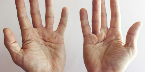 Dupuytren’s Contracture – Its Symptoms and Causes