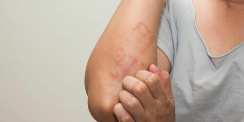 Eczema &#8211; Types, Causes, Symptoms, and Treatment