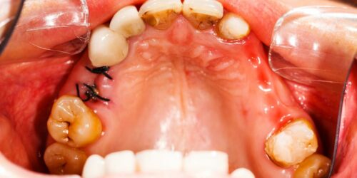 Effective Home Remedies to Treat Cavities