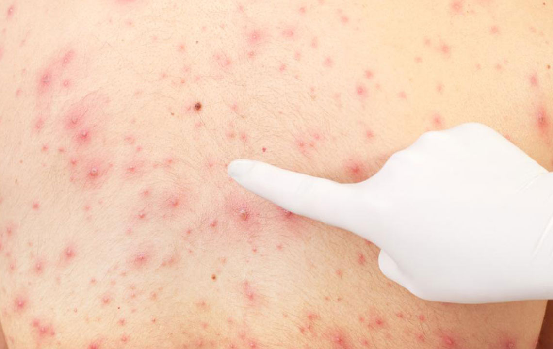 Effective Remedies for Treating Skin Rashes