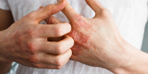 Foods to Eat and Avoid for Patients with Eczema