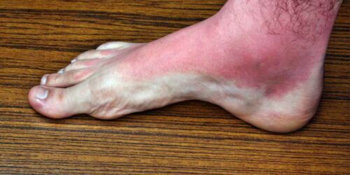 Heat rash:Â Causes, symptoms, and treatment