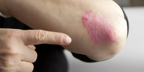 Here Are a Few Things to Know about Psoriasis