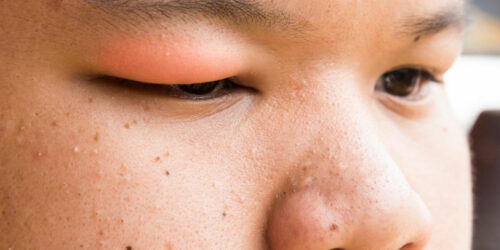 Here&#8217;s How to Get Rid of a Stye With These Simple Steps