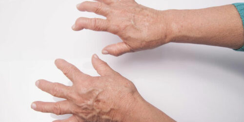 Here&#8217;s What You Need to Know About Rheumatoid Arthritis Symptoms