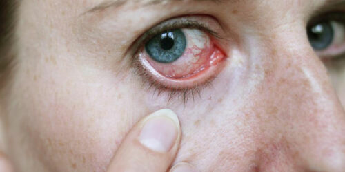 How to Treat Pink Eye with Eye Drops