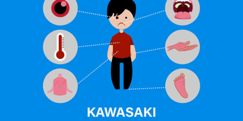 Kawasaki disease &#8211; causes and symptoms