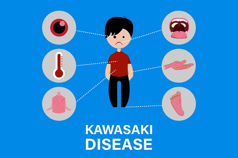 Kawasaki disease &#8211; causes and symptoms