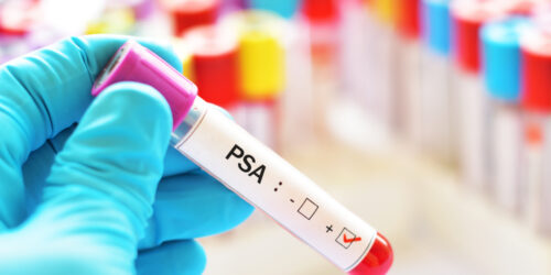 Know About Psa Levels And How To Lower Them