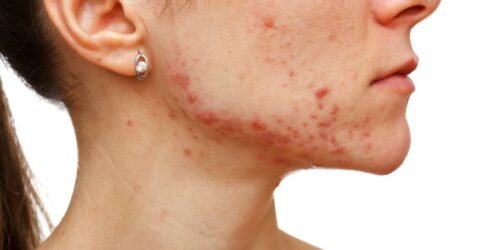 Know About The Symptoms Of Different Types Of Eczema