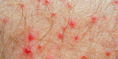 Know Everything about Atopic Dermatitis