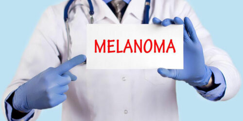 Know about the Diagnosis and Treatment Options for Metastatic Melanoma