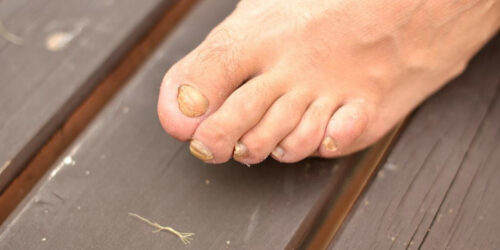 Most Beneficial Home Remedies for Toenail Fungus