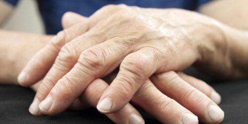 Rheumatoid Arthritis &#8211; Symptoms, Causes, and Remedies