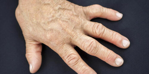 Signs of Rheumatoid Arthritis You Should Look out For