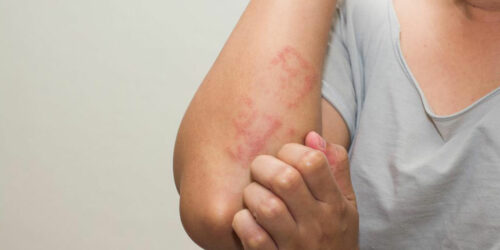 Signs and Symptoms of Lupus You Need to Be Aware Of