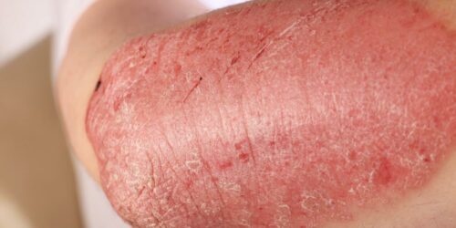 Symptoms, Causes, Types And Treament Of Eczema