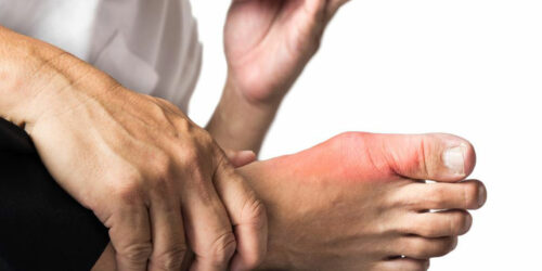 Symptoms and Treatments for Gout