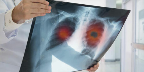 Symptoms and Treatments for Non-Small Cell Lung Cancer